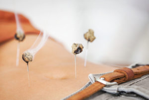 Acupuncture With Moxibustion