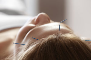 Acupuncture on the Head
