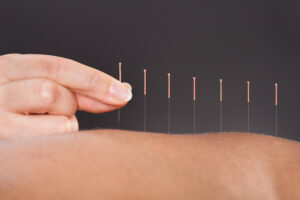 Acupuncture For Breakup