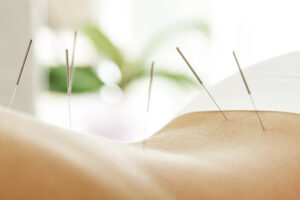 Acupuncture In Eastern Medicine