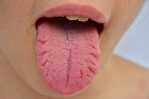 Tongue In Eastern Medicine