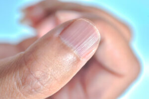 Ridged Fingernails in Eastern Medicine