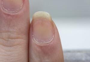 Yellow Fingernails in Eastern Medicine