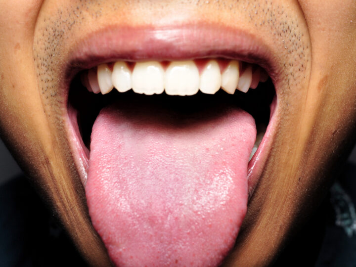 The Significance of Tongue Diagnosis in TCM Dermatology